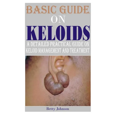 Basic Guide on Keloids: A detailed practical guide on keloid management and treatment