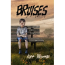 Bruises