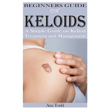 Beginners Guide on Keloids