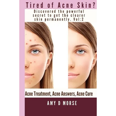 TIRED OF ACNE SKIN? Discover the Powerful Secrets to get Clearer Skin Permanently