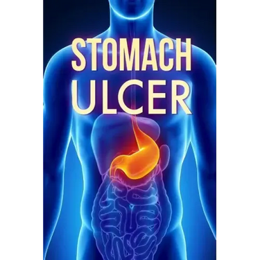Stomach Ulcer: Treatment in 60 days!: Stomach Ulcer treatment
