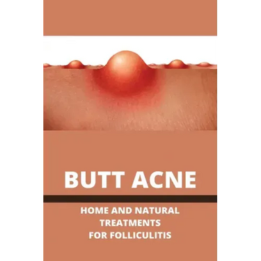 Butt Acne: Home And Natural Treatments For Folliculitis: Barber'S Itch Home Remedies
