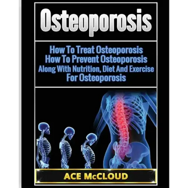 Osteoporosis: How To Treat Osteoporosis: How To Prevent Osteoporosis: Along With Nutrition, Diet And Exercise For Osteoporosis