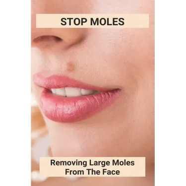 Stop Moles: Removing Large Moles From The Face: Surefire Way To Get Rid Of Moles