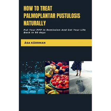 How To Treat Palmoplantar Pustulosis Naturally: Put Your PPP In Remission And Get Your Life Back in 90 days