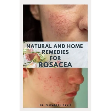 Natural and Home Remedies for Rosacea: A Self Help Guide To Completely Prevent and Treat Rosacea