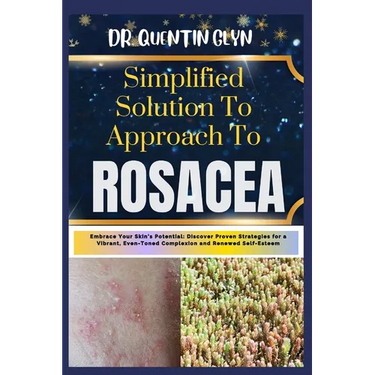 Simplified Solution Approach To ROSACEA: Embrace Your Skin's Potential: Discover Proven Strategies for a Vibrant, Even-Toned Complexion and Renewed Se