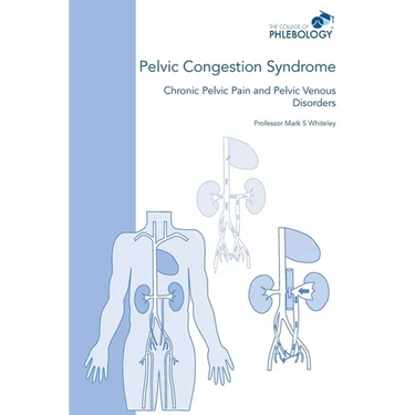 Pelvic Congestion Syndrome - Chronic Pelvic Pain and Pelvic Venous Disorders