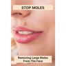Stop Moles: Removing Large Moles From The Face: Surefire Way To Get Rid Of Moles