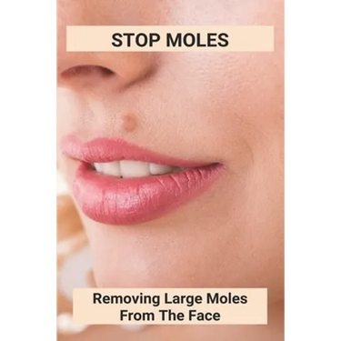 Stop Moles: Removing Large Moles From The Face: Surefire Way To Get Rid Of Moles