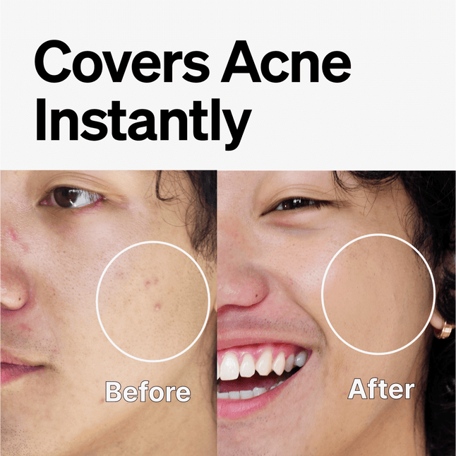 Skintone Acne Treatment by FRONTMAN