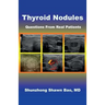 Thyroid Nodules: Questions From Real Patients