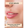 Stop Moles: Removing Large Moles From The Face: Surefire Way To Get Rid Of Moles
