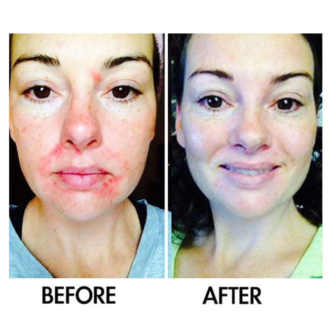 SkinSanity® Acne Treatment - Clear Skin Results Regimen by Best Clean Beauty