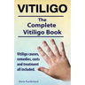Vitiligo. Vitiligo causes, remedies, costs and treatment all included. The complete Vitiligo Book.