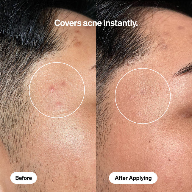 Skintone Acne Treatment by FRONTMAN