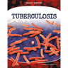 Tuberculosis
